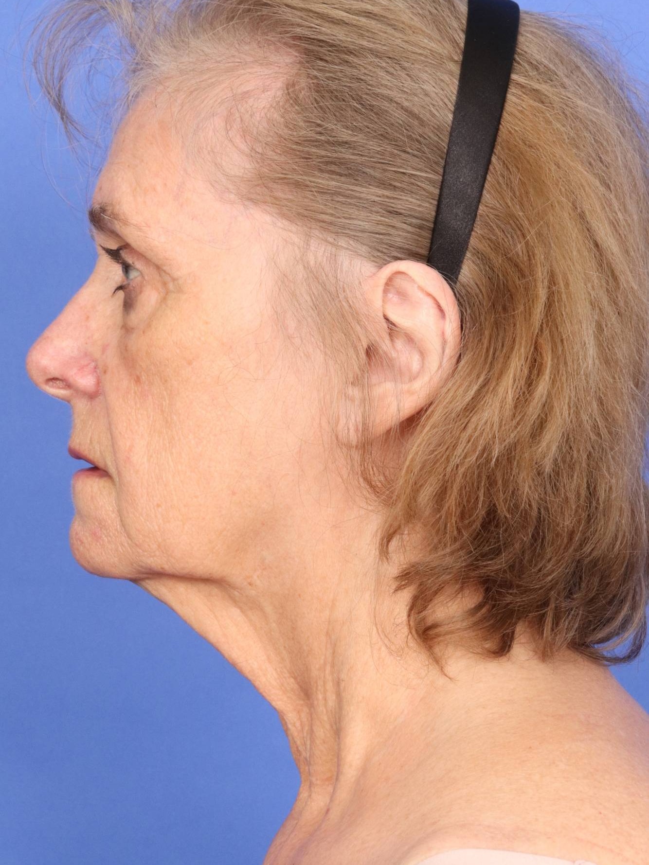 Facelift Before & After Image