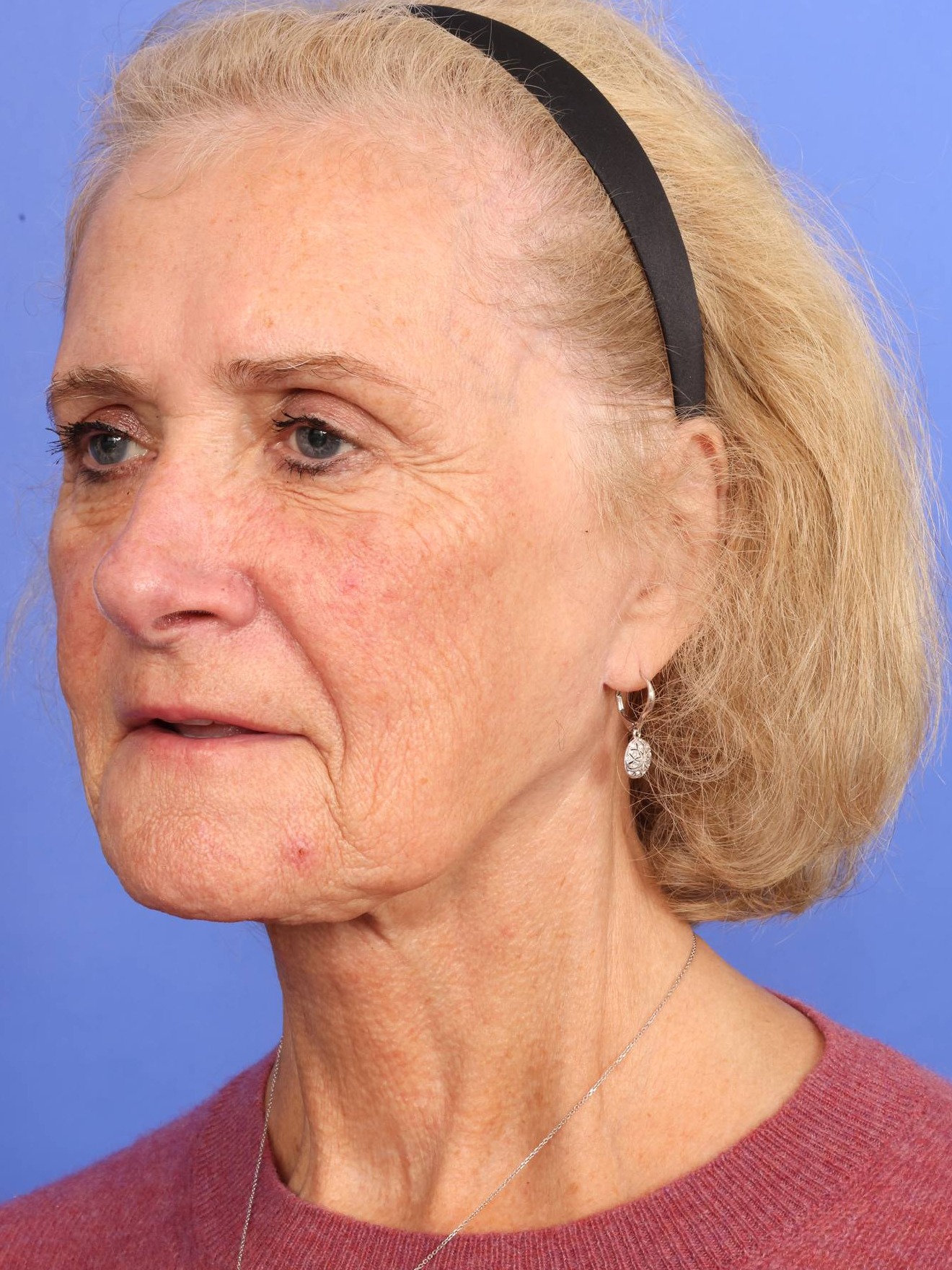 Facelift Before & After Image