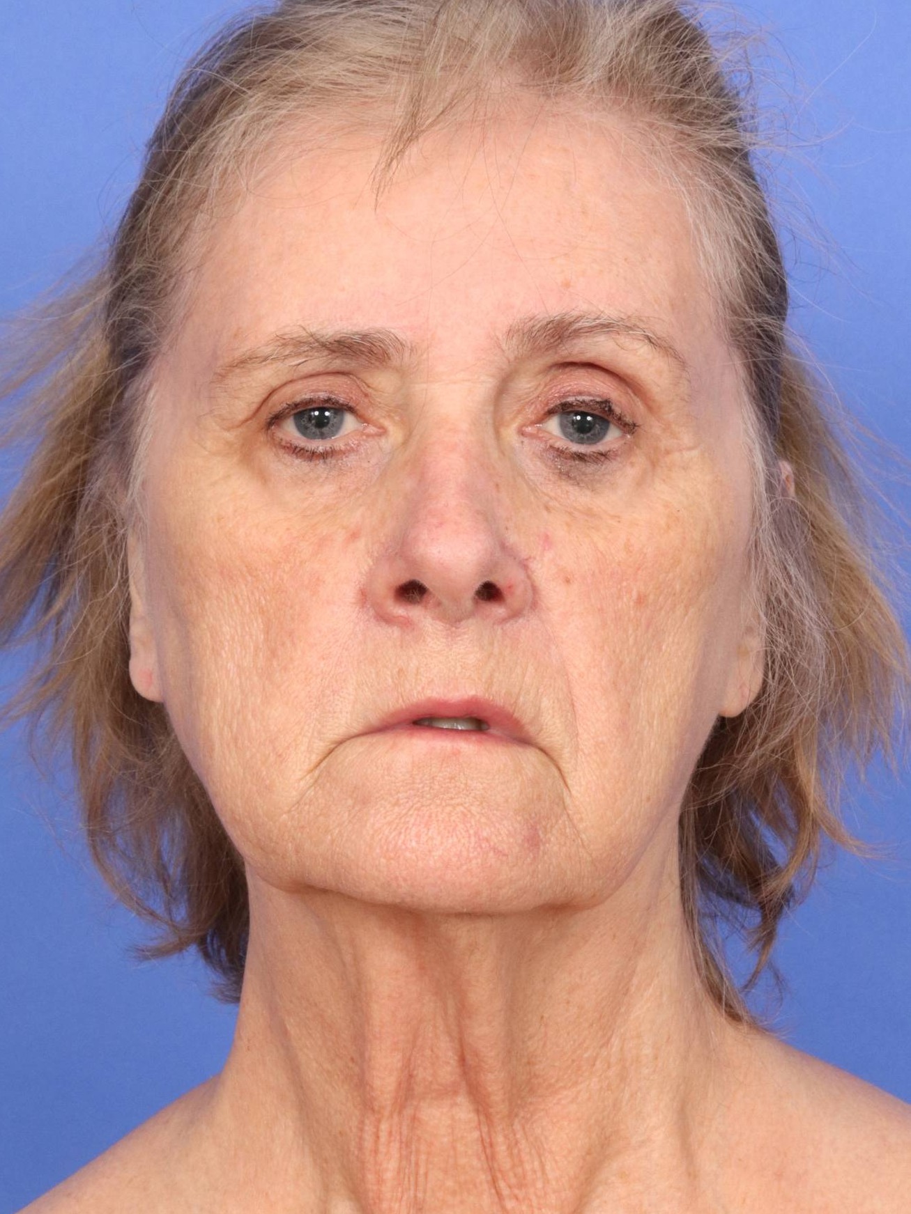 Facelift Before & After Image