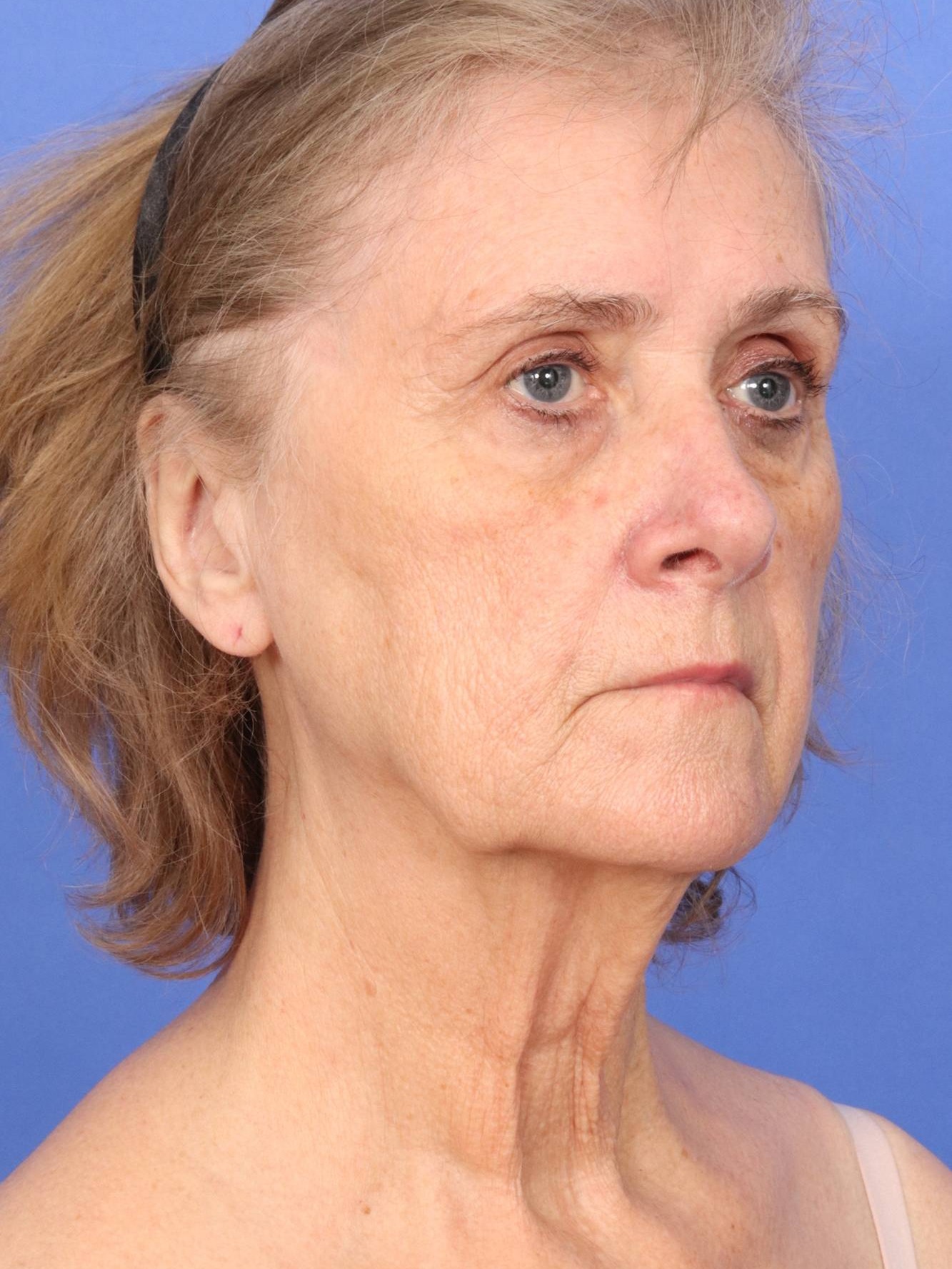 Facelift Before & After Image