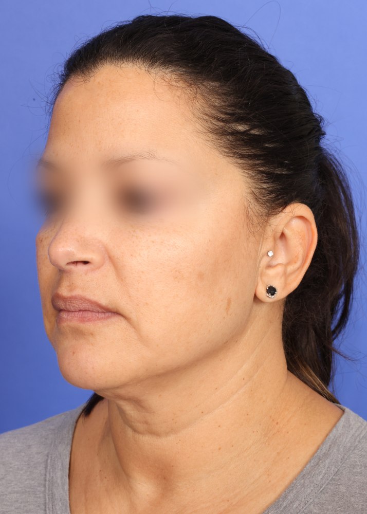 Facelift Before & After Image