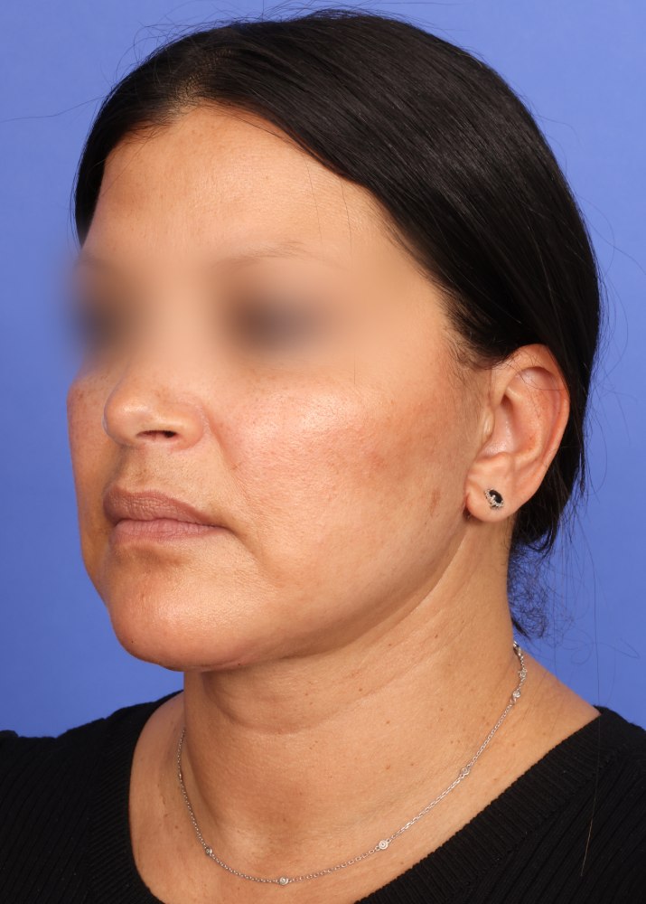 Facelift Before & After Image