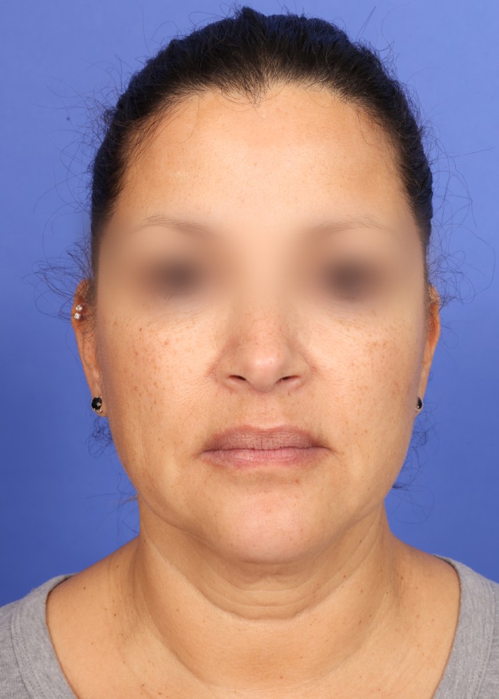 Facelift Before & After Image