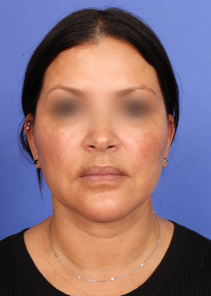 Facelift Before & After Image