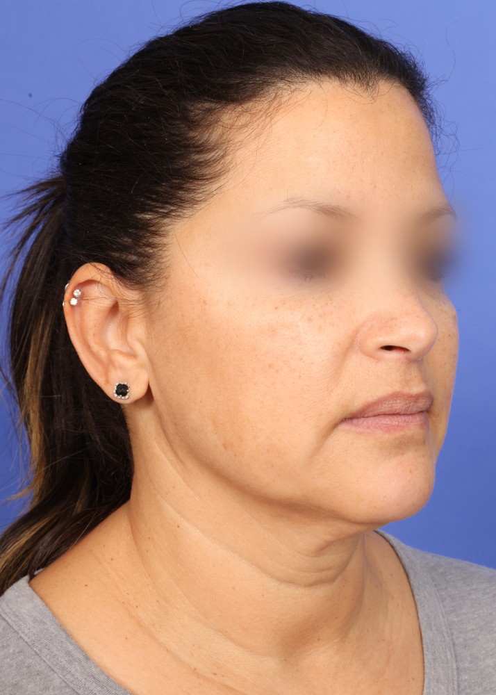 Facelift Before & After Image