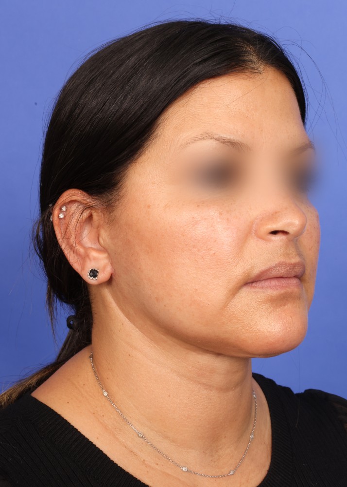 Facelift Before & After Image