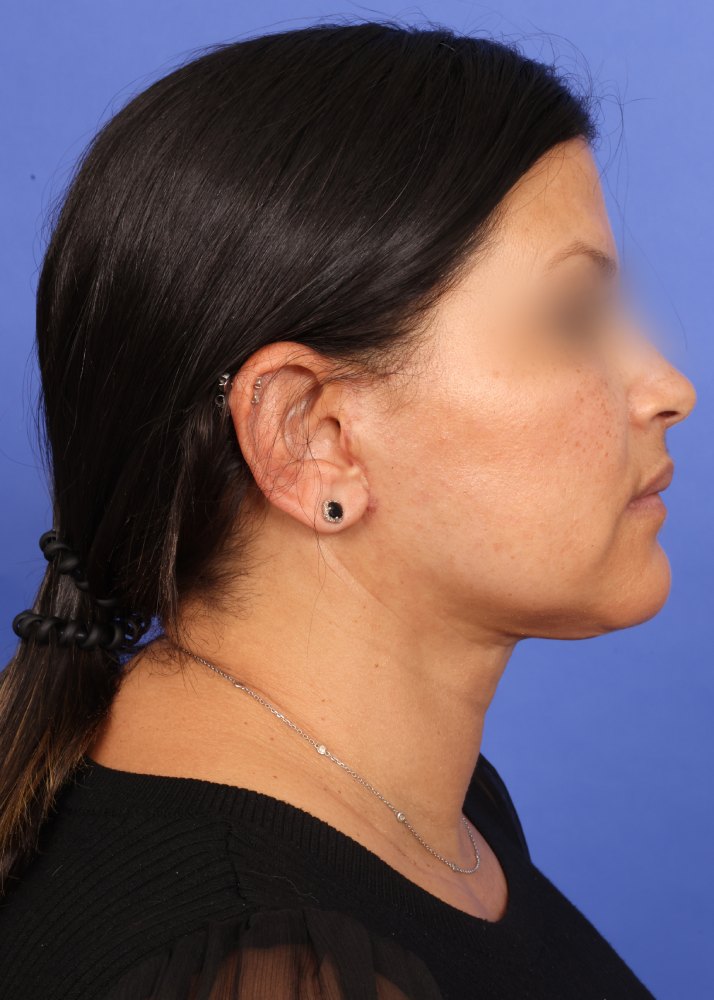 Facelift Before & After Image