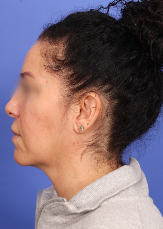 Facelift Before & After Image