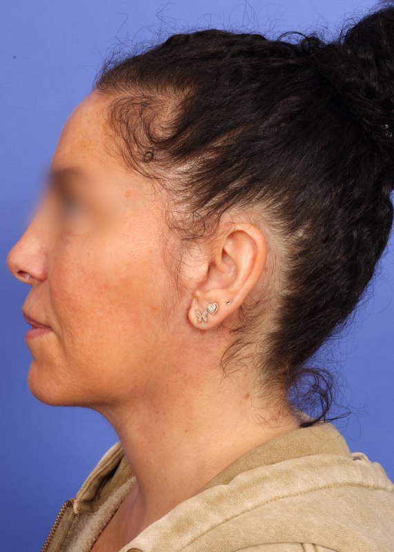 Facelift Before & After Image