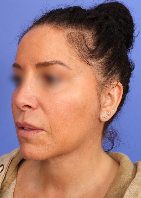 Facelift Before & After Image