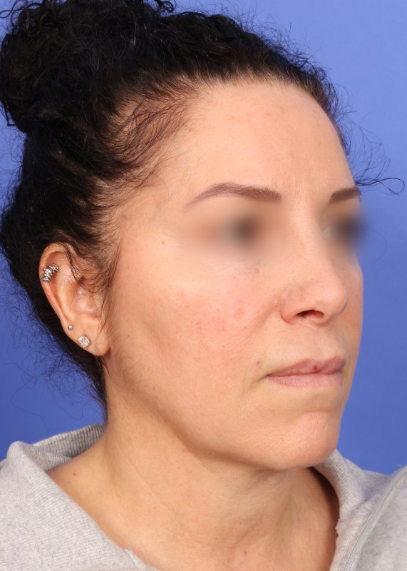 Facelift Before & After Image