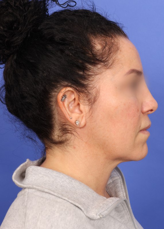 Facelift Before & After Image