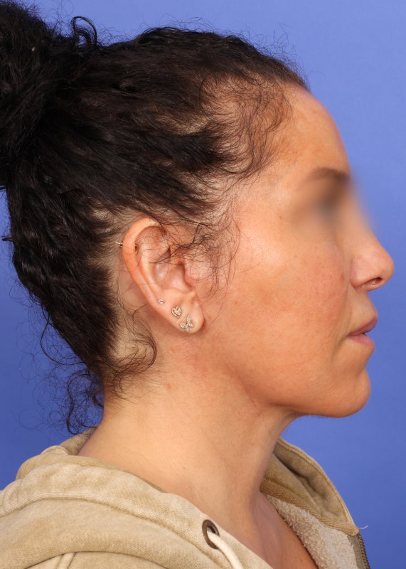 Facelift Before & After Image