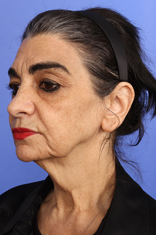 Facelift Before & After Image