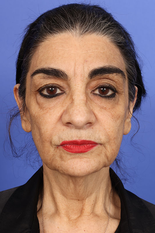 Facelift Before & After Image