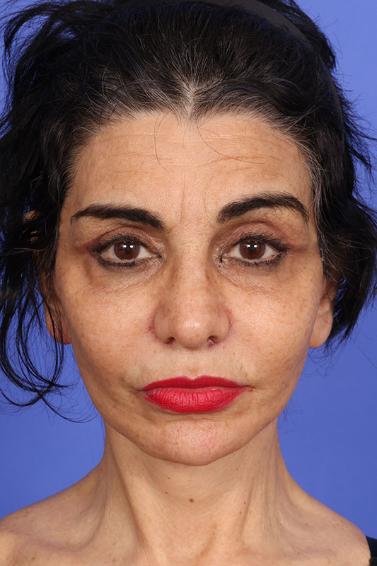 Facelift Before & After Image