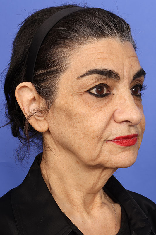 Facelift Before & After Image