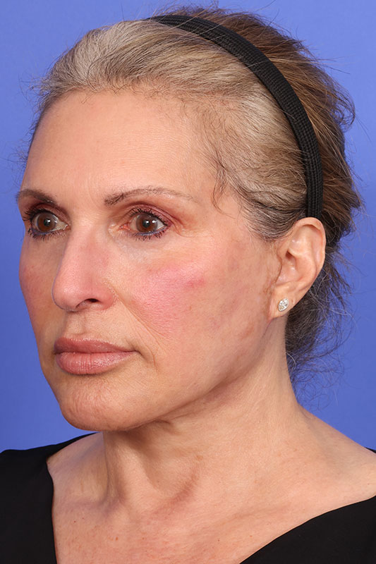 Facelift Before & After Image