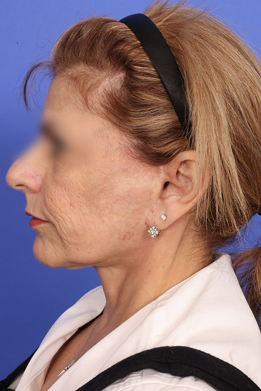 Facelift Before & After Image