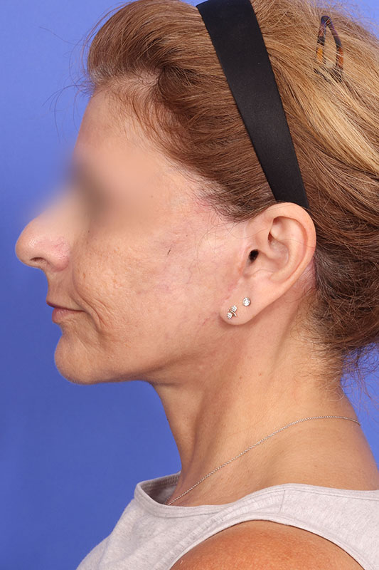 Facelift Before & After Image