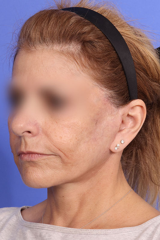 Facelift Before & After Image