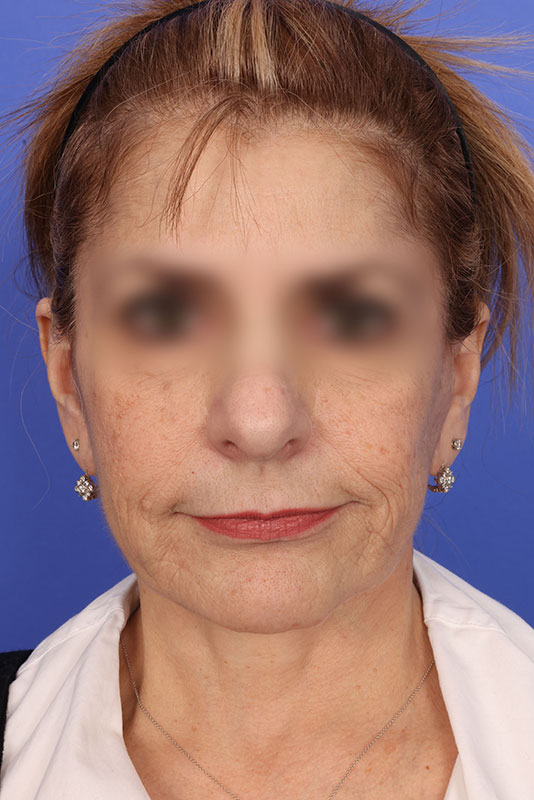 Facelift Before & After Image
