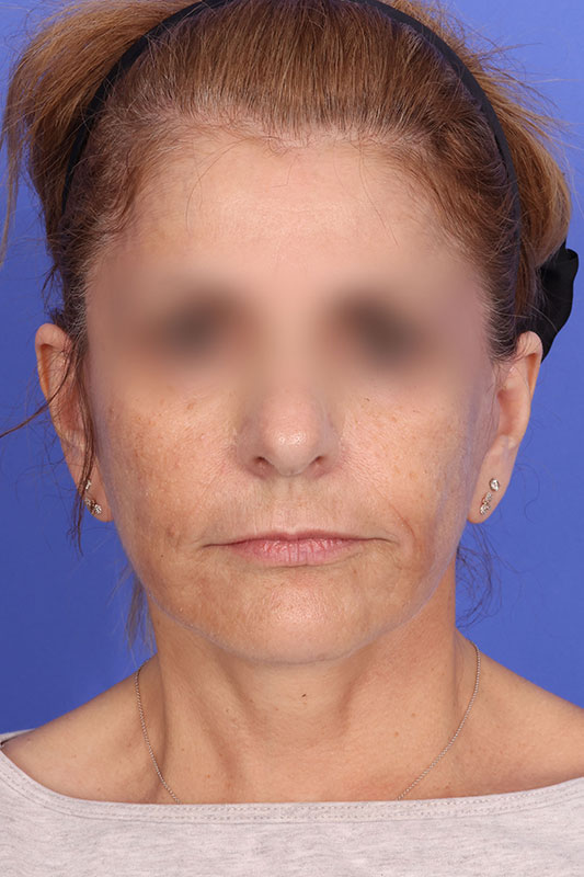 Facelift Before & After Image