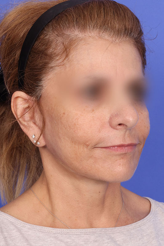 Facelift Before & After Image