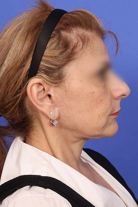 Facelift Before & After Image