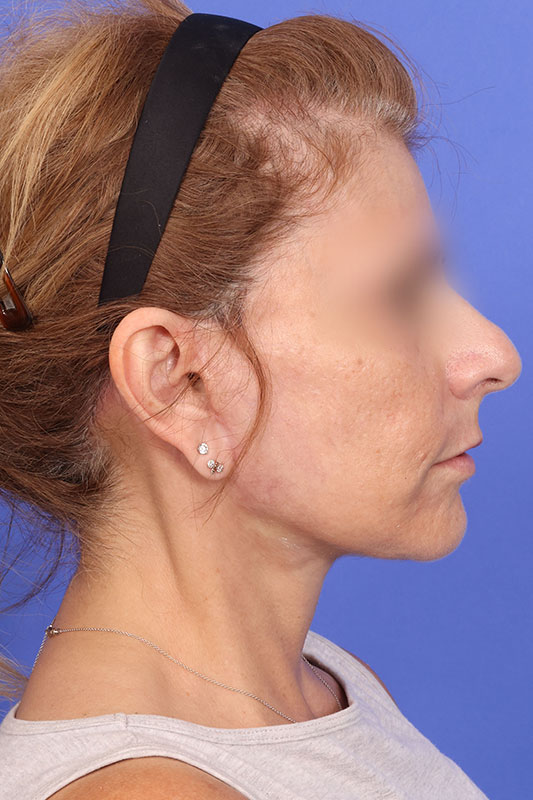 Facelift Before & After Image