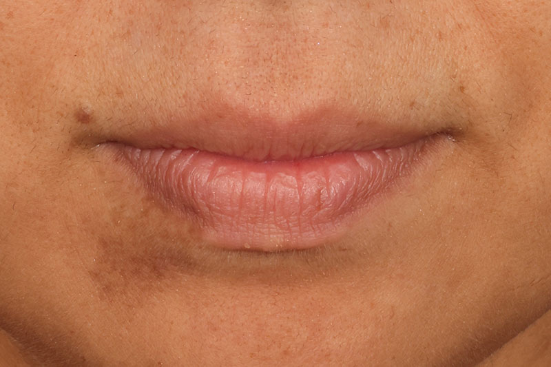 Fillers Before & After Image