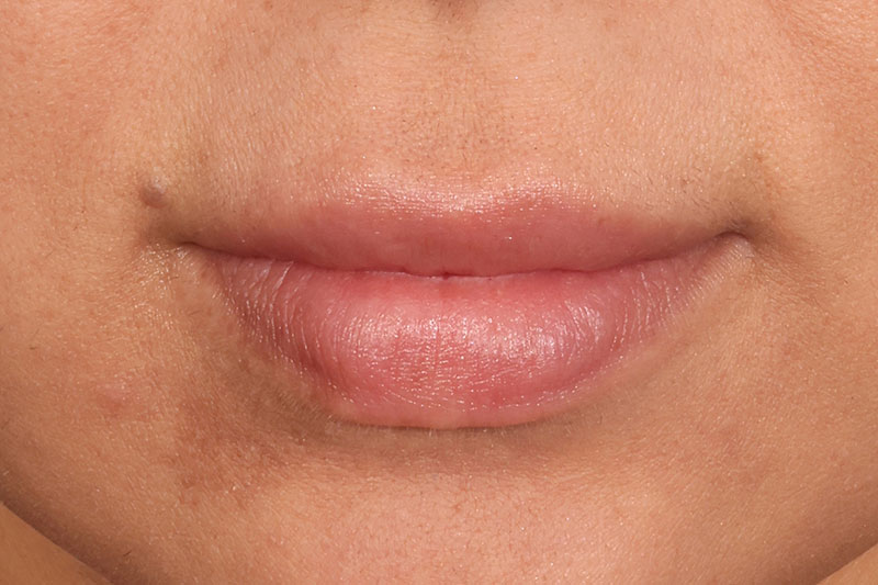 Fillers Before & After Image