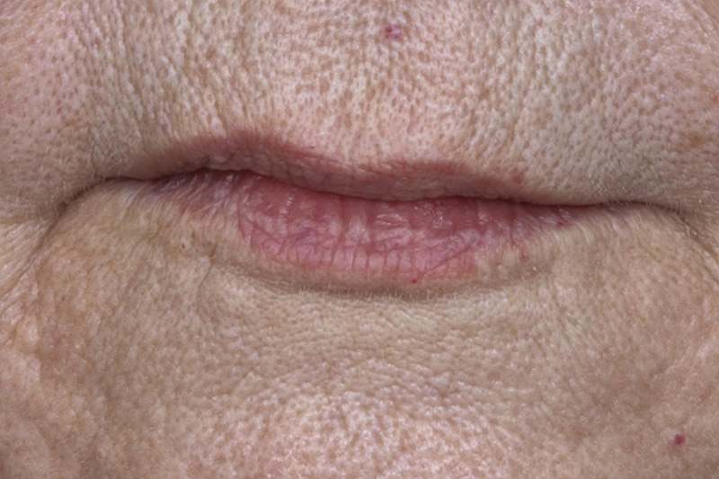 Lip Lift Before & After Image