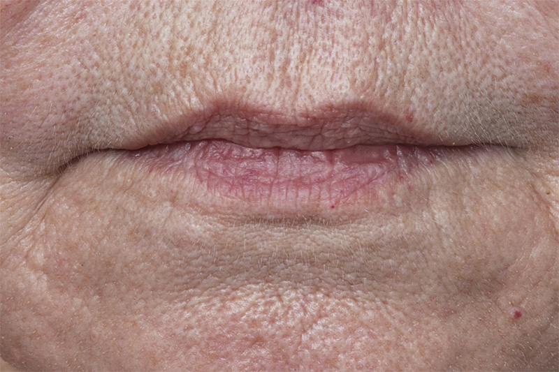 Lip Lift Before & After Image