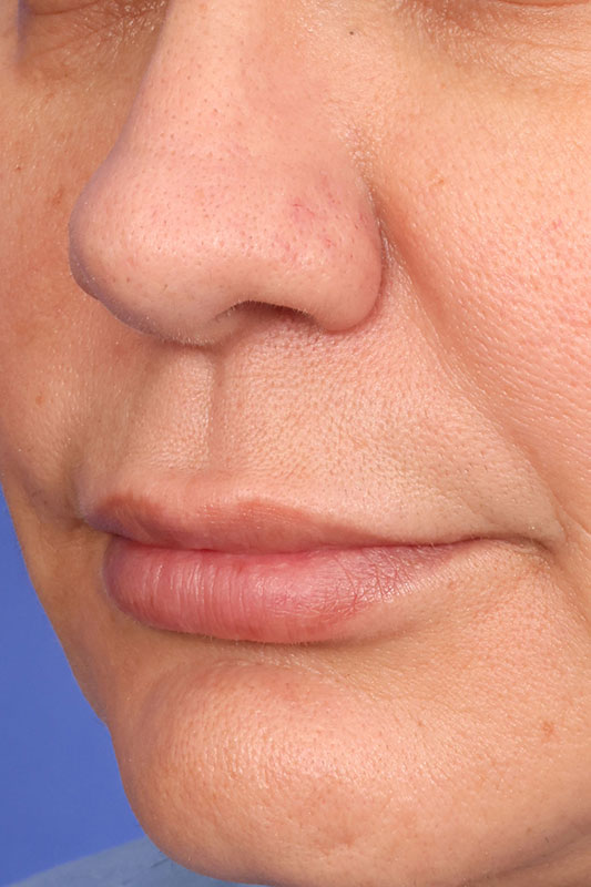 Lip Lift Before & After Image