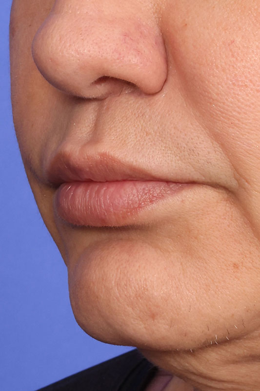 Lip Lift Before & After Image