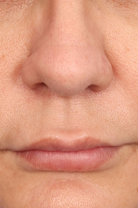 Lip Lift Before & After Image