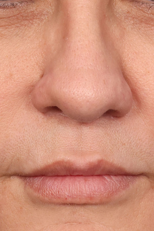 Lip Lift Before & After Image