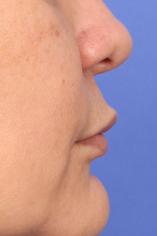 Lip Lift Before & After Image