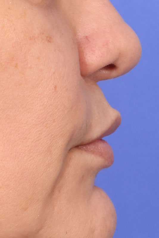 Lip Lift Before & After Image
