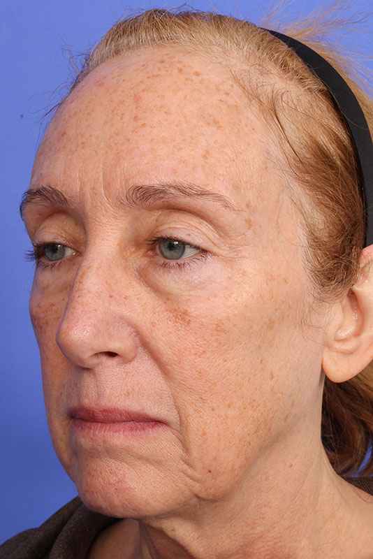 Moxi Before & After Image