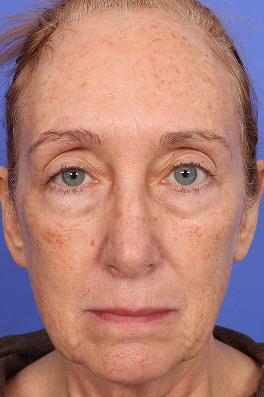 Moxi Before & After Image