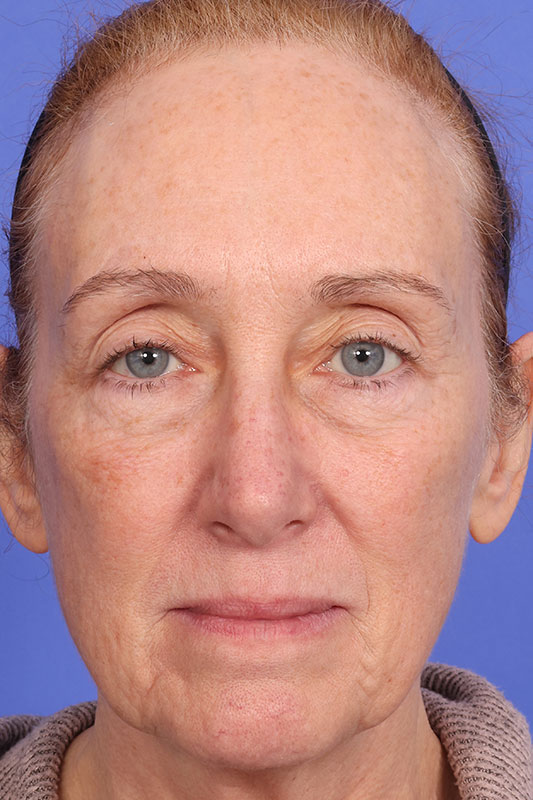 Moxi Before & After Image