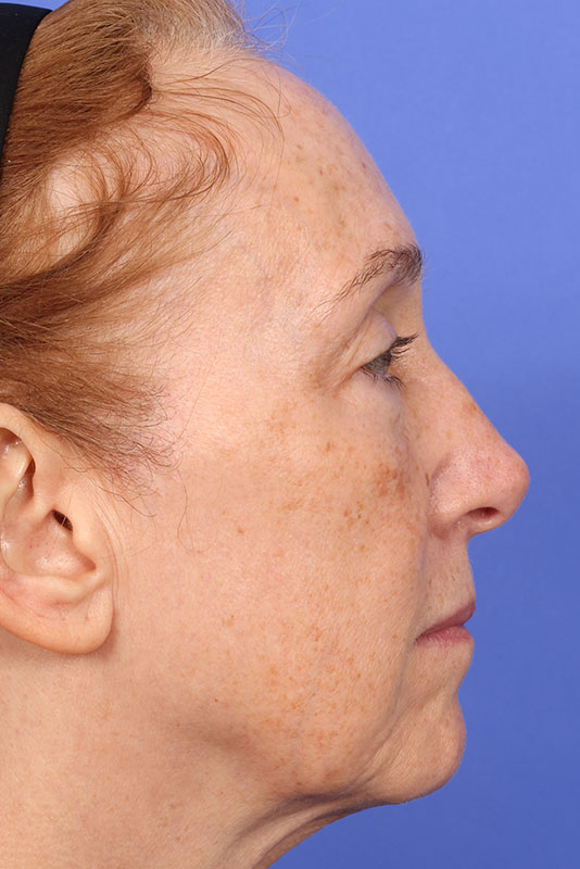 Moxi Before & After Image