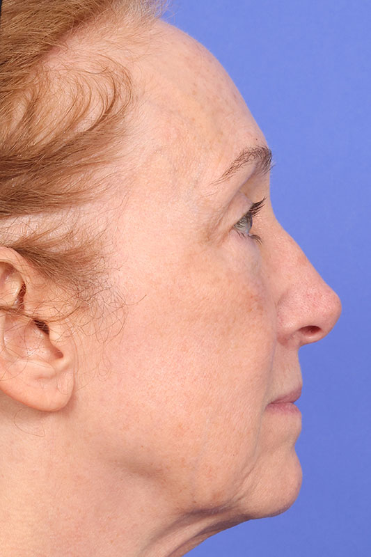 Moxi Before & After Image