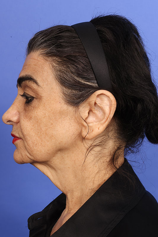 Neck Lift Before & After Image