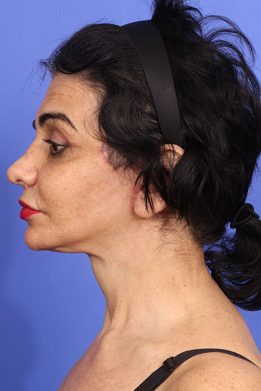 Neck Lift Before & After Image