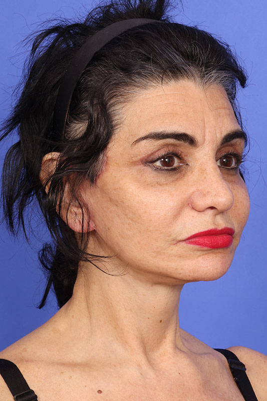 Neck Lift Before & After Image