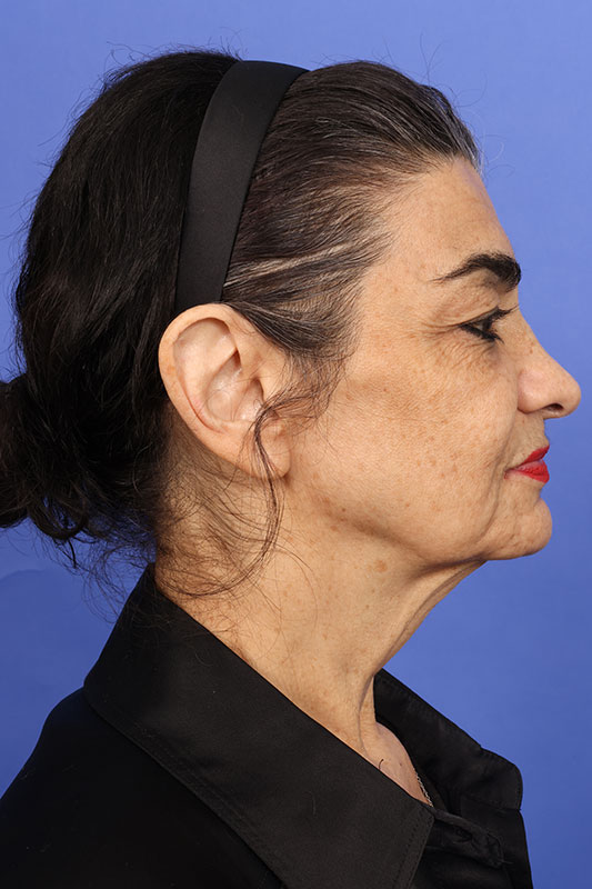 Neck Lift Before & After Image