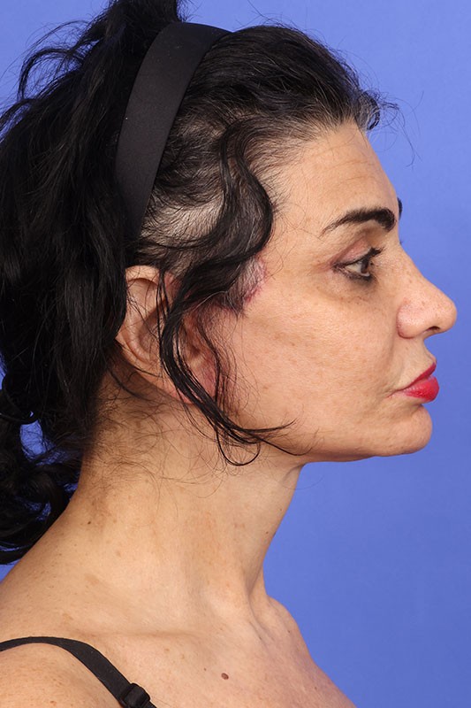 Neck Lift Before & After Image